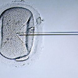 IVF treatment. Light micrograph of a micro-needle (right) about to inject human sperm into a human egg cell. This technique used for in vitro fertilisation (IVF) is known as intracytoplasmic sperm injection (ICSI). The injected sperm fertilises the egg. The resulting zygote is then grown in the lab until it reaches an early stage of embryonic development. It is then implanted in the patient's uterus. Several embryos are usually implanted to give the greatest chance of a successful pregnancy. However, this can result in multiple births. IVF allows infertile couples to conceive a child.,Image: 102405109, License: Rights-managed, Restrictions: , Model Release: no, Credit line: Profimedia