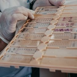 Zafarbené histologické rezy tkaniva na detekciu rakovinových buniek